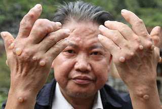 Penyebab Muncul Kutil yang ada di Alat Kelamin, Artikel Obat untuk Kutil di kelamin Pria, Beli Obat Herbal Kutil Kelamin Wanita