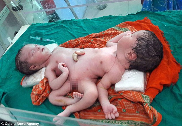 Indian mother who gave birth to conjoined twins sharing nearly every organ ...
