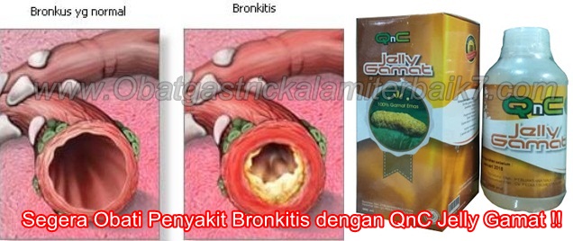 Cara Ampuh Menyembuhkan Bronkitis Secara Total Cara Ampuh Menyembuhkan Bronkitis Secara Total