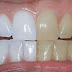 How To Whiten Your Teeth With Turmeric