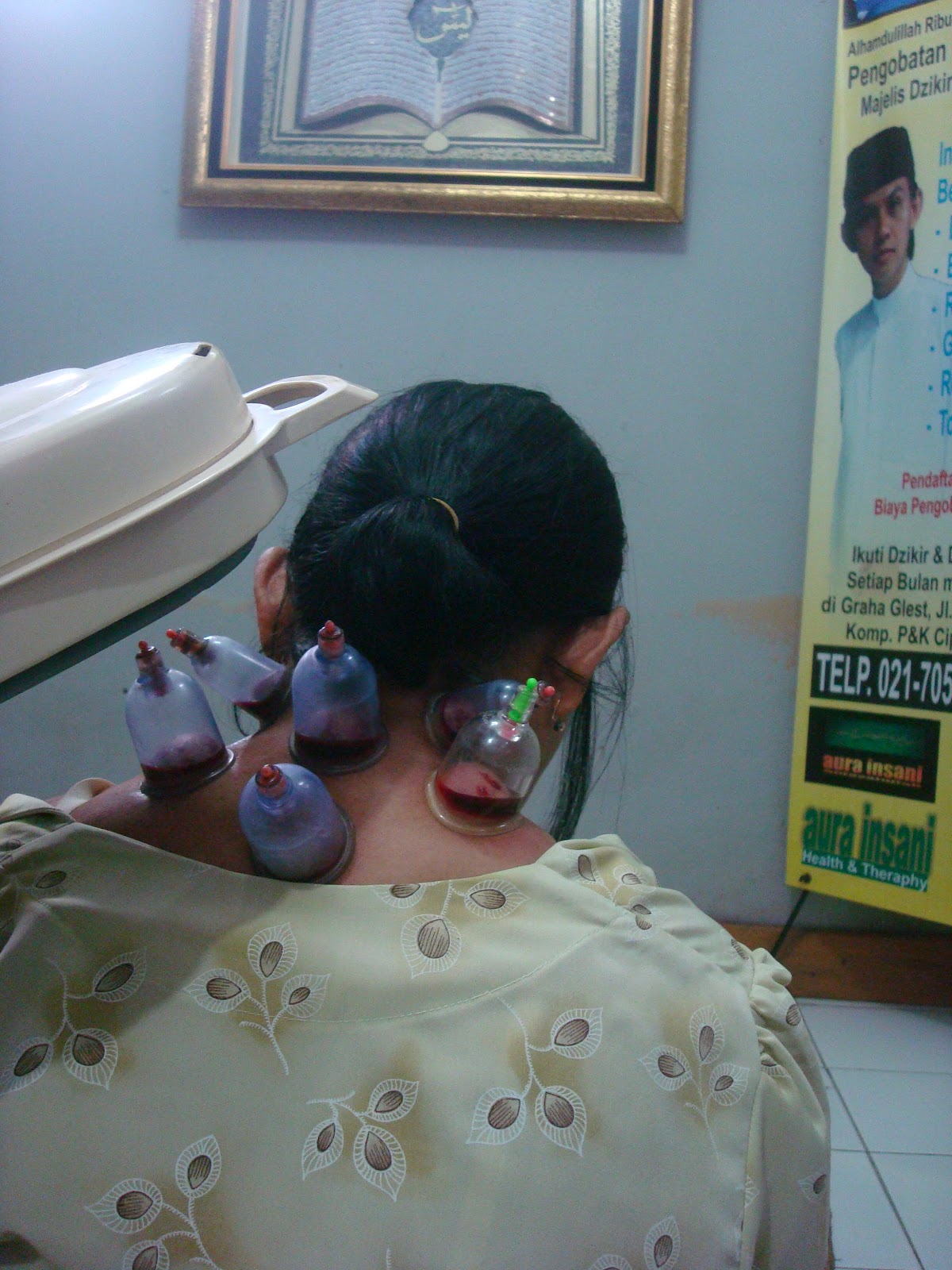 Badan Tidak Masuk Angin Lagi Setelah Melakukan Terapi bekam Di Bekam