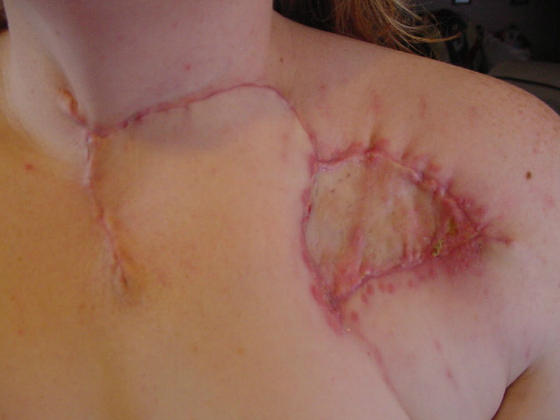 Keloïd litteken behandeling: wat moet je doen?