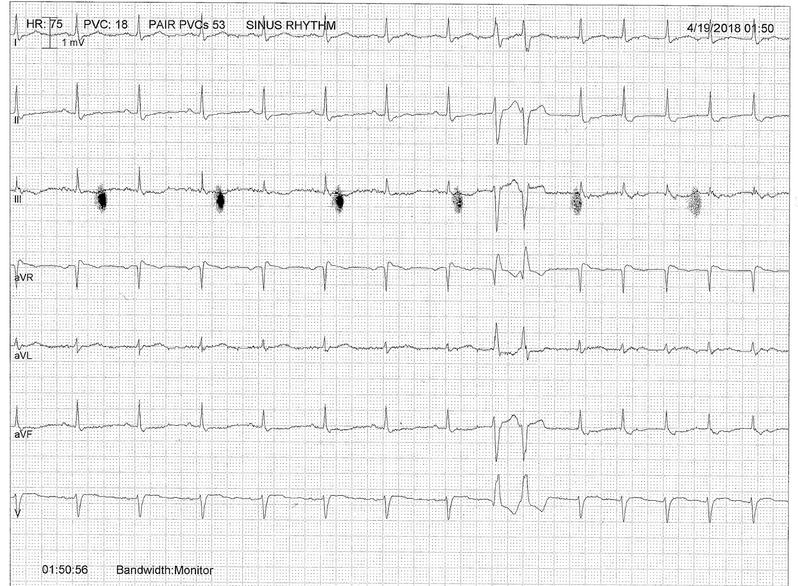 ECG Rhythms Junctional Tachycardia True or False