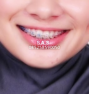 Warna Karet Behel Yang Cantik Di Gigi Ide Perpaduan Warna