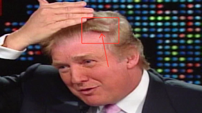 Donald Trump hairline