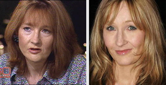 JK Rowling Plastic Surgery Before and After Good or Bad | Plastic Surgery