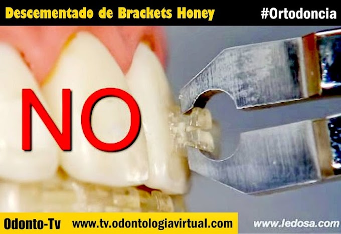 ORTODONCIA: Descementado Bracket Honey