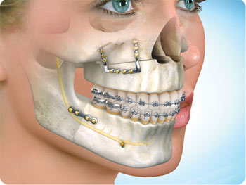 Oral Surgery Jaw 41