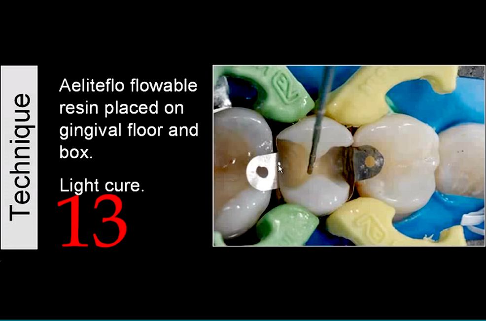 POSTERIOR RESTORATIVE Simplified posterior direct resin composites
