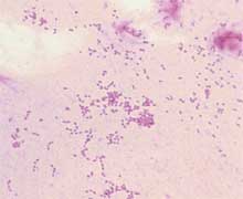 Bordetella Pertussis Bakteri Penyebab Penyakit Batuk Rejan atau Batuk