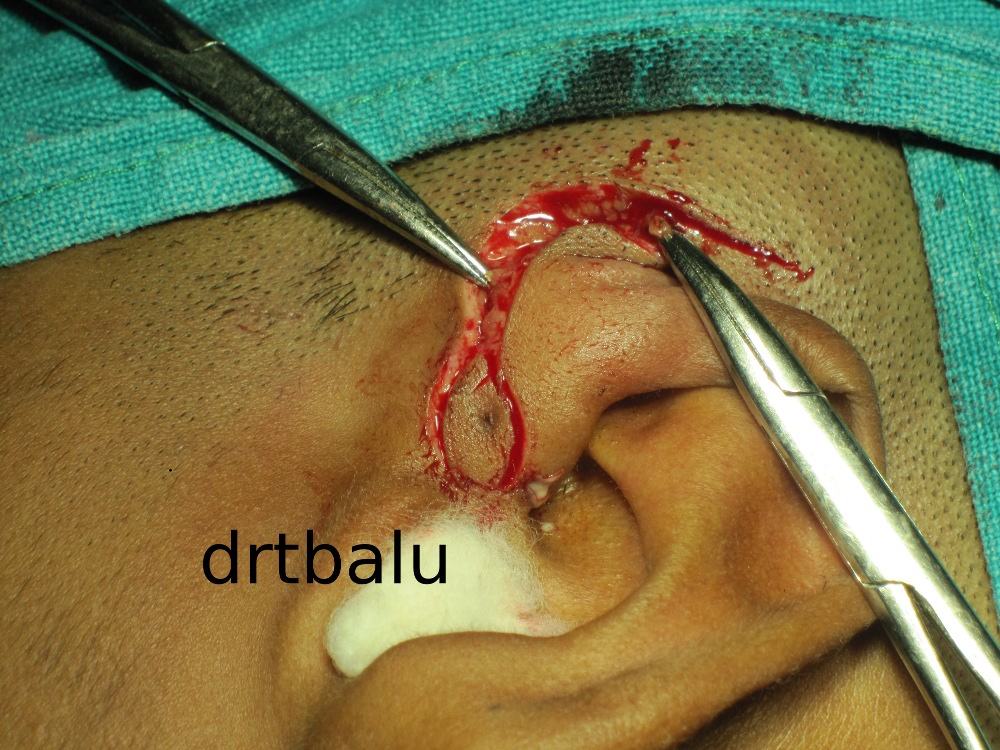 49+ Preauricular Pit Removal Images