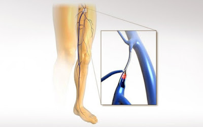 Ανώδυνη ενδοφλεβική θεραπεία κιρσών με laser
 
Ανώδυνη ενδοφλεβική θεραπεία κιρσών με laser