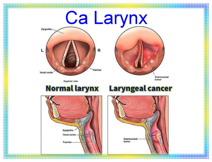 Ca larynx