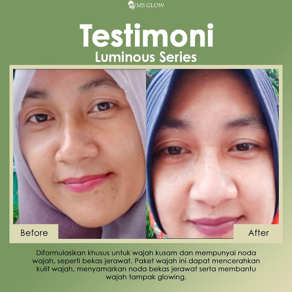 testimoni ms glow skin care