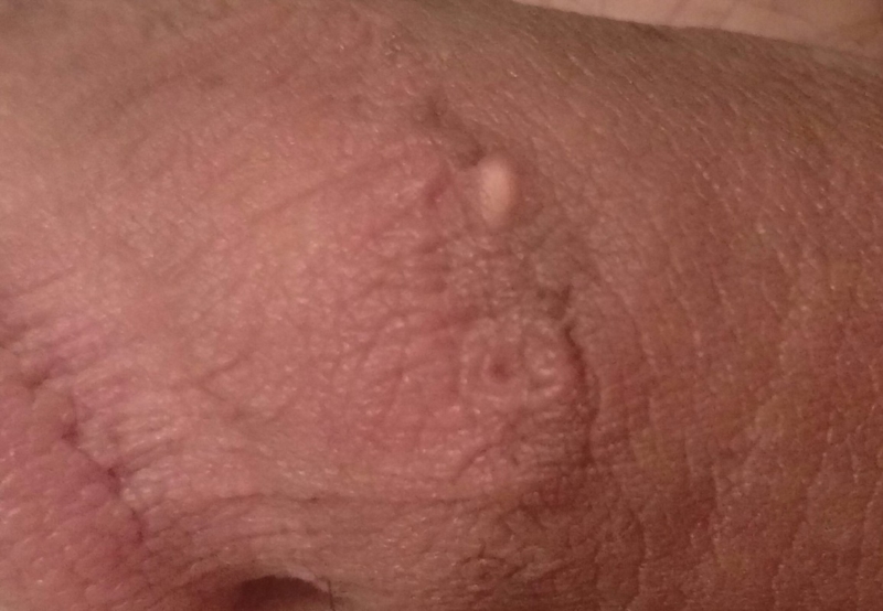 45 Causes of Bumps on Penis