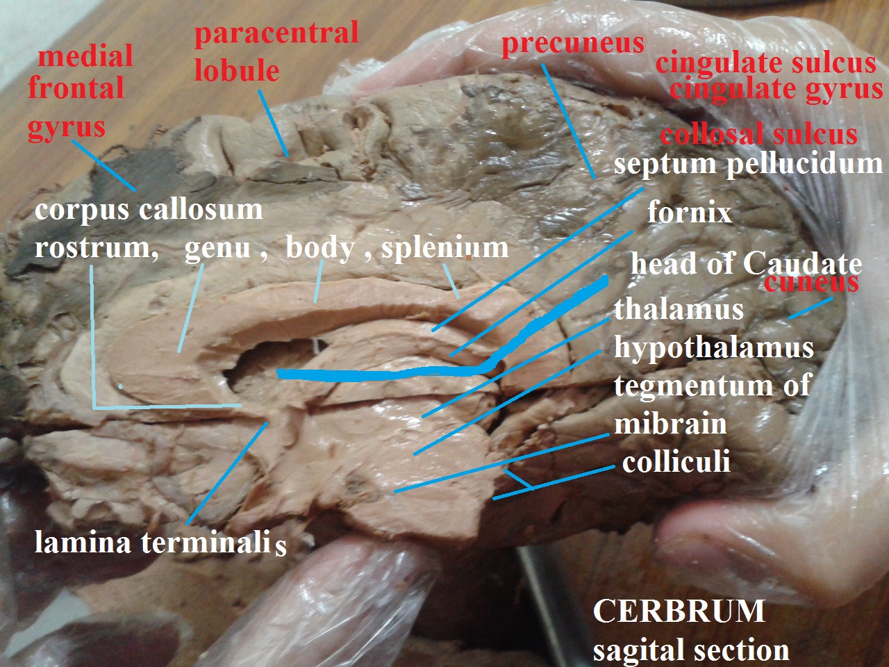 neuroanatomy labelled specimen for 2nd yr mbbs spotting superior orbital fissure