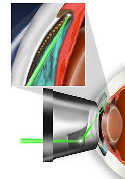 Glaucoma Therapy, Selective Laser Trabeculoplasty (SLT)