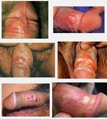 sipilis obat sipilis manjur