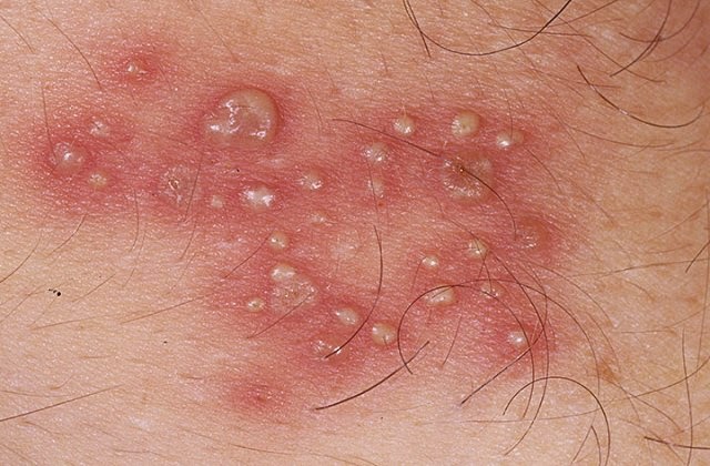 genital herpes blister picture