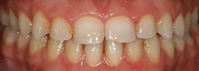 crown lengthening before photo