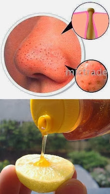 Blackheads | Amazing Things You Could Do With Lemons We Bet You Never Knew