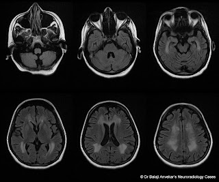 Dr Balaji Anvekar FRCR: Vit B12 deficiency MRI brain findings