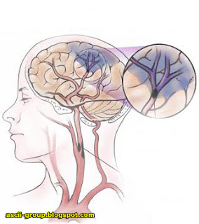 أربع مسببات للسكتة الدماغية عند الرجال Stroke in men أربع مسببات للسكتة الدماغية عند الرجال Stroke in men