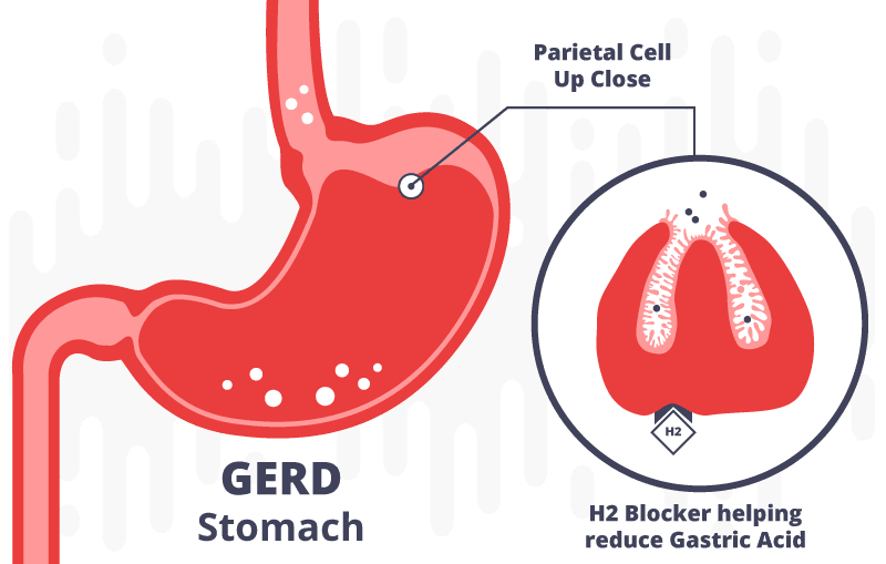 HOW TO TREAT AND PREVENT PEPTIC ULCERS.