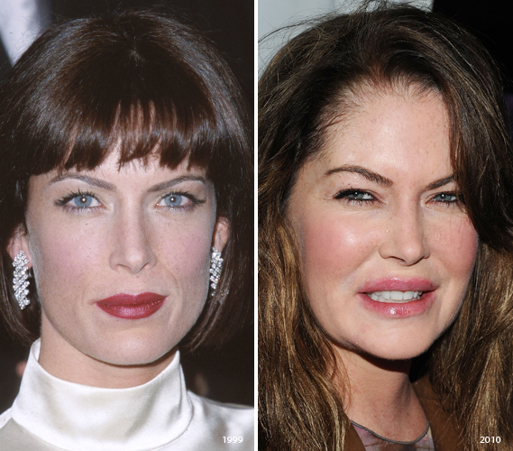 Lara Flynn Boyle Plastic Surgery Before And After