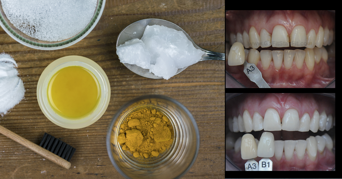 This Turmeric AntiInflammatory Paste Will Reverse Gum Disease