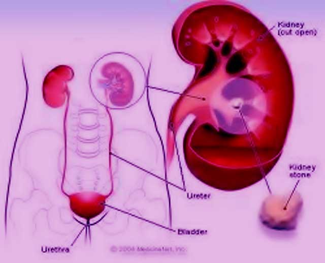 Homeopathy solutions for kidney stone treatment কিডনী পাথর চিকিৎসায় হোমিওসমাধান