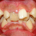  Quy trình bọc răng sứ cho răng mọc lệch 