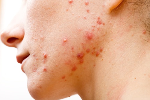 Las cepas bacterianas se relacionan con el acné