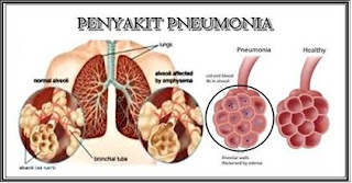 Penyakit Pneumonia