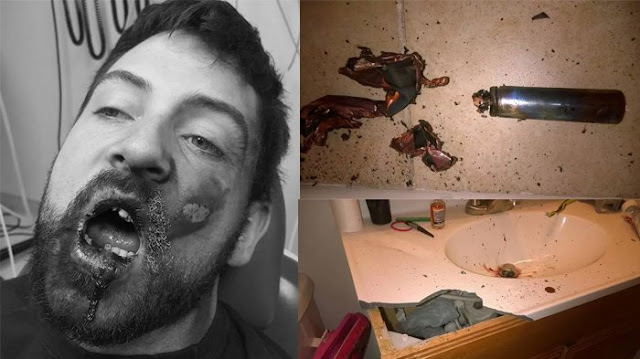 Waspada Ancaman Vaping, Pria ini Kehilangan Gigi dan Wajahnya Rusak Akibat Rokok Elektrik! Waspada Ancaman Vaping, Pria ini Kehilangan Gigi dan Wajahnya Rusak Akibat Rokok Elektrik!