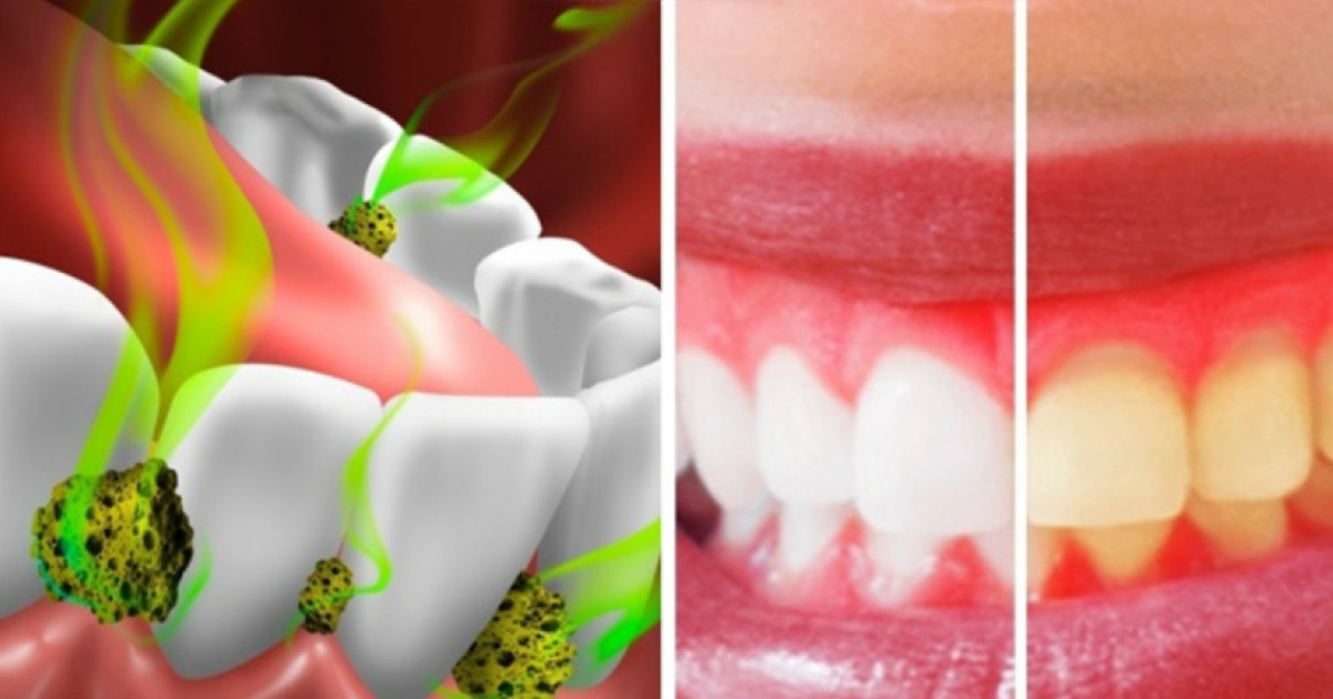 14 Ways to Reduce Bacteria in Your Mouth and