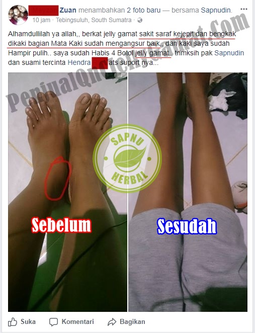 Cara Menghilangkan Nyeri Di Pergelangan Kaki Kanan dan Kiri Terbukti Mujarab ~ TESTIMONI JELLY GAMAT QNC Cara Menghilangkan Nyeri Di Pergelangan Kaki Kanan dan Kiri Terbukti Mujarab ~ TESTIMONI JELLY GAMAT QNC