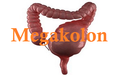 Cara Mengobati Megakolon Secara Alami Khasiat Utama Teripang Emas