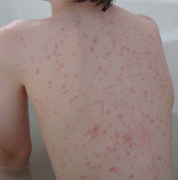 Chickenpox (Varicella) Symptoms, Treatment, Causes - What ...