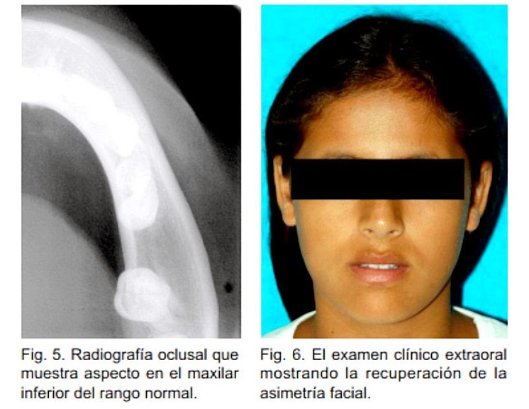 PDF Osteomielitis Crónica con Periostitis Proliferativa