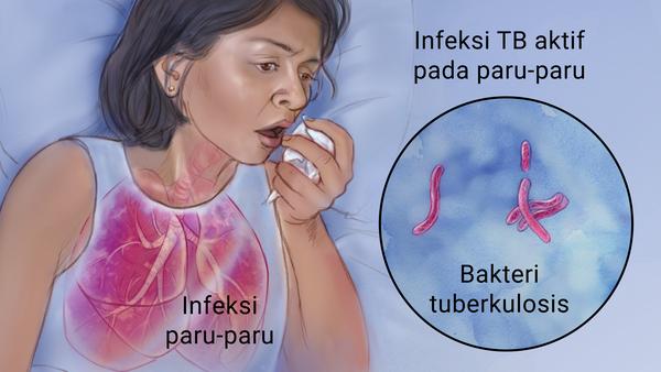 ilustrasi pengidap tbc