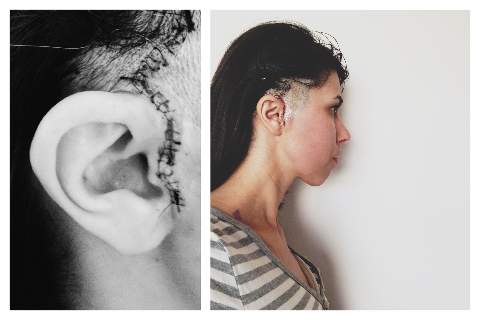 TMJ diaries Recovering