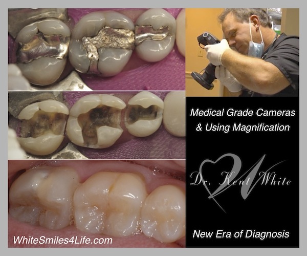 Niche Dental Marketing Good for Silver Dental Amalgam Fillings to Often Outlast Your Natural Teeth?