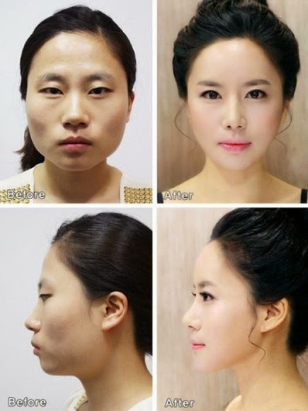 61 Contoh Foto Operasi Plastik Orang Korea