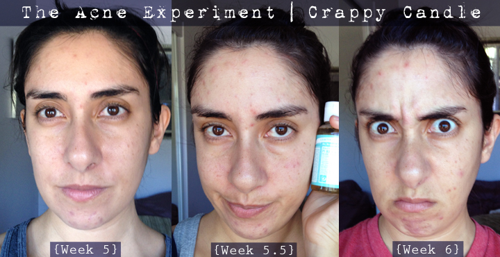 Dr. Bronners for POD/Acne Before and After :: The Acne Experiment