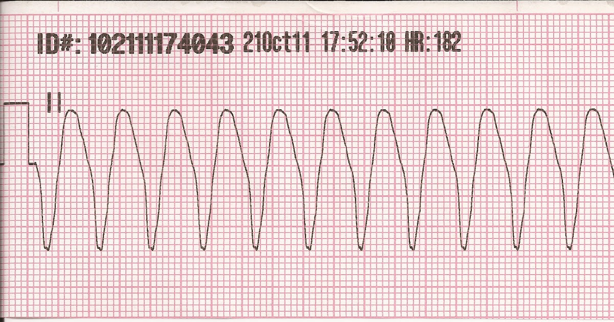 Float Nurse: Pediatric Pulseless Ventricular Tachycardia (VT) and