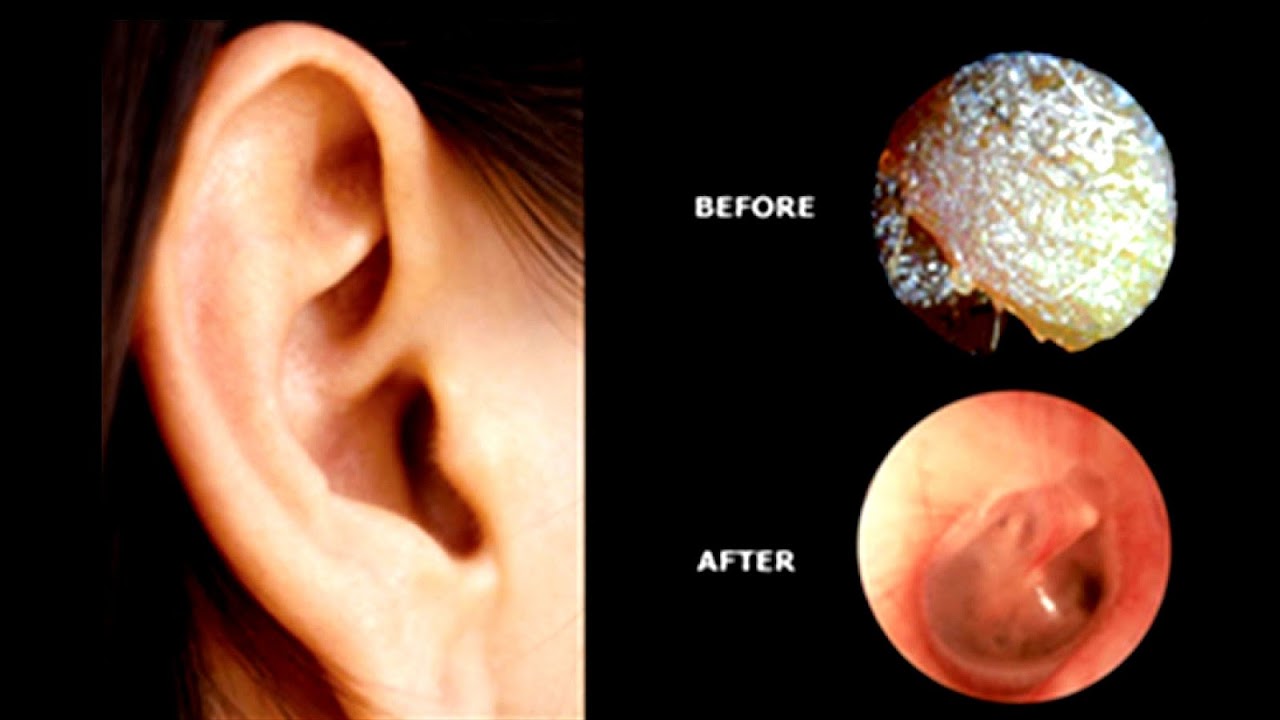 Previous Tennitus Louder After Ear Infection Tinnitus Treatment