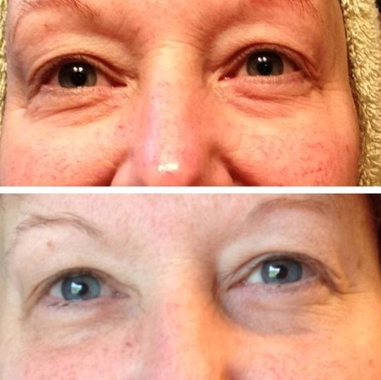 NonInvasive And Natural Facelifts Using Face Aerobics Exercises