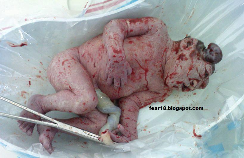 Baby Born With Penis And Vagina 48