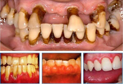 Các triệu chứng viêm chân răng người bệnh cần biết-1